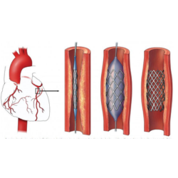 Angiography and Angioplasty